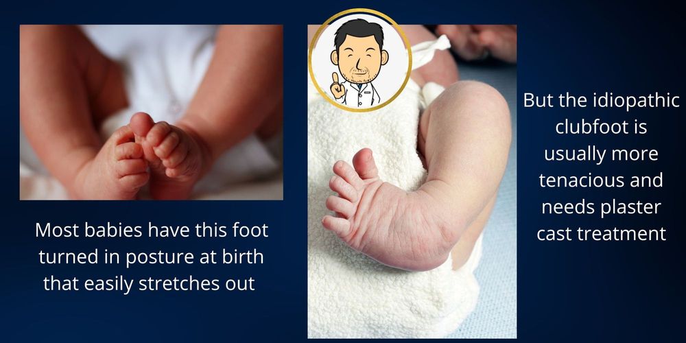 clubfoot-treatment