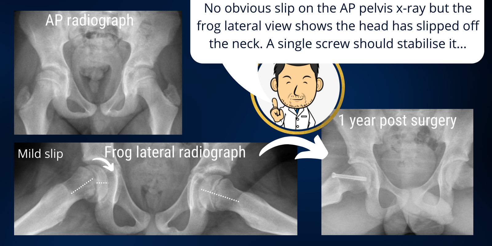 Slipped Upper Femoral Epiphysis